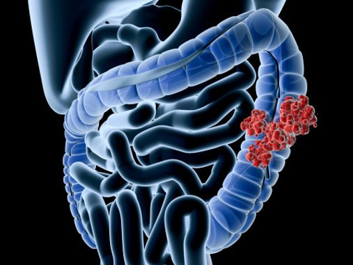 A 3D rendered image of a small intestine with a collection of red blobs present.